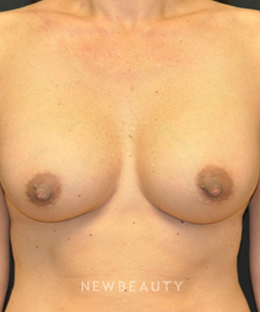 dr-andrew-smith-breast-augmentation-b