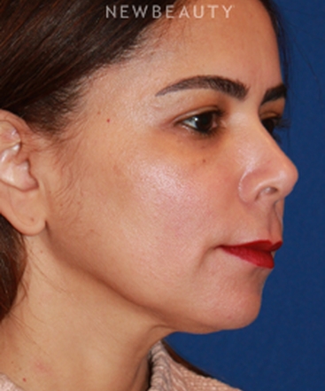 dr-dilip-d-madnani-mini-facelift-b