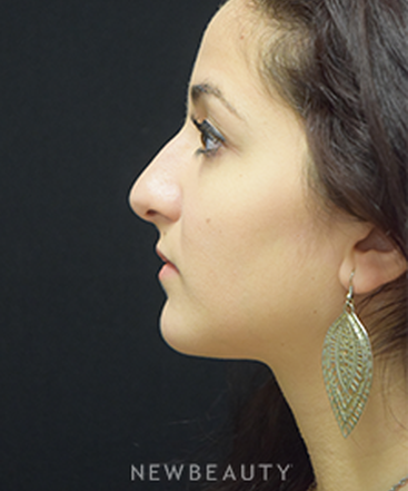 dr-jeffrey-b-wise-rhinoplasty-b