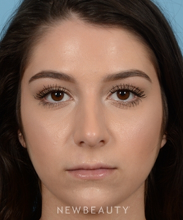 dr-jeffrey-b-wise-rhinoplasty-b