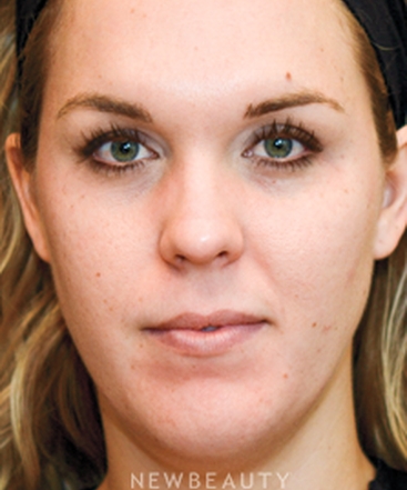 dr-janet-allenby-nonsurgical-facial-contouring-b