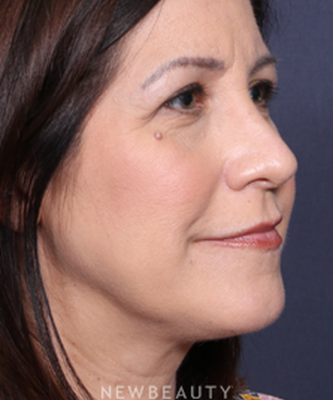 la-jolla-cosmetic-surgery-rhinoplasty-b