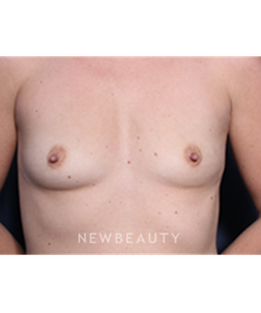 ljcsc-dr-roark-breast-augmentation-b