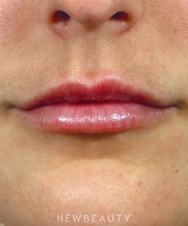 dr-kenneth-r-beer-the-art-of-lip-enhancement-b