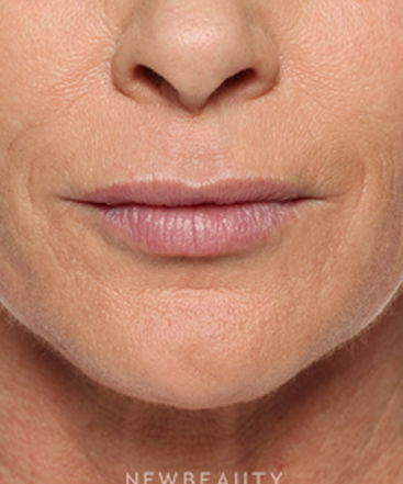 dr-marina-peredo-lip-enhancement-b