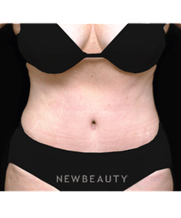 dr-andrew-smith-tummy-tuck-liposuction-b