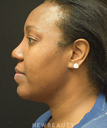dr-jeffrey-b-wise-lipo-rhinoplasty-b