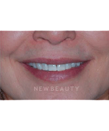 dr-guy-lewis-veneers-b