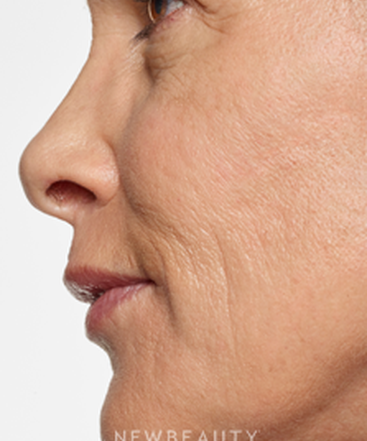 dr-marina-peredo-lip-enhancement-b
