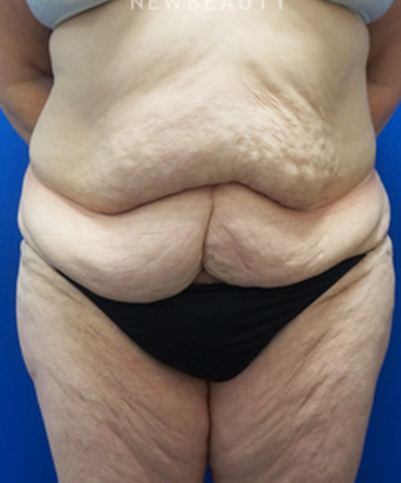 dr-niki-christopoulos-liposuction-b