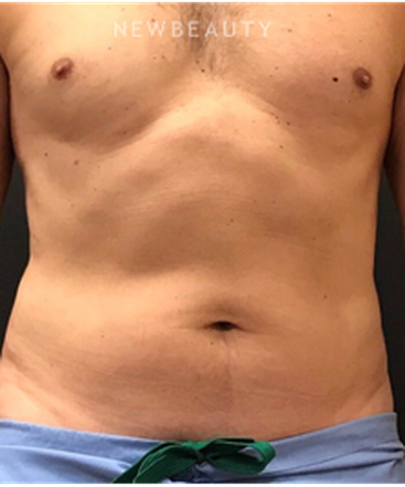 dr-janet-allenby-coolsculpting-b