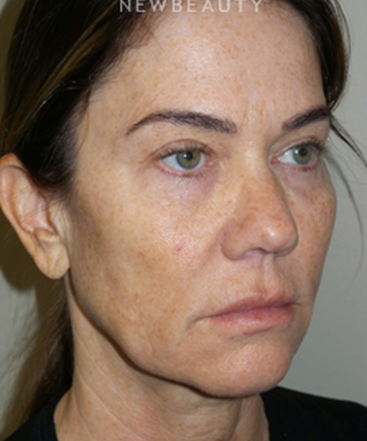 dr-sanjay-grover-facelift-b