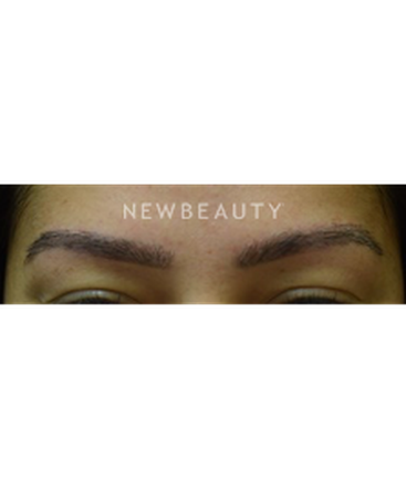 dr-jeffrey-b-wise-eyebrow-hair-restoration-b