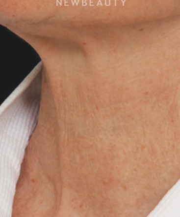 drs-jennifer-segal-scott-smith-microneedling-b