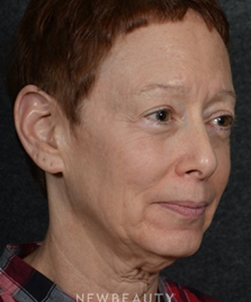 dr-ryan-chastant-facelift-b