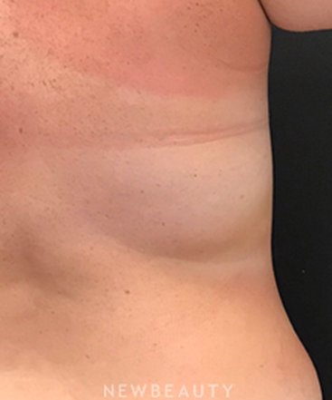 dr-janet-allenby-coolsculpting-b