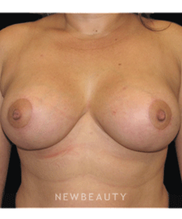 dr-sean-simon-breast-augmentation-breast-lift-b