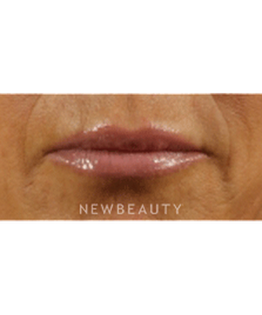 dr-marina-peredo-lip-augmentation-b