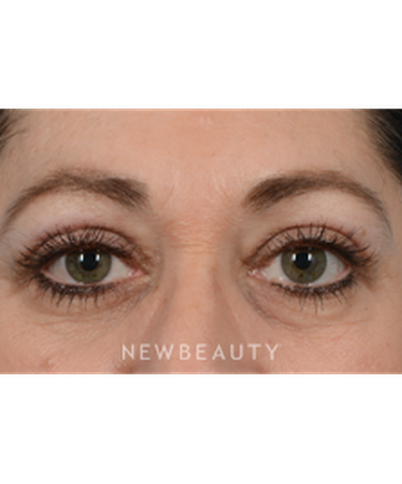 dr-jeffrey-wise-upper-blepharoplasty-b