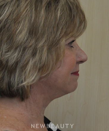 dr-andrew-smith-facelift-eyelift-necklift-b