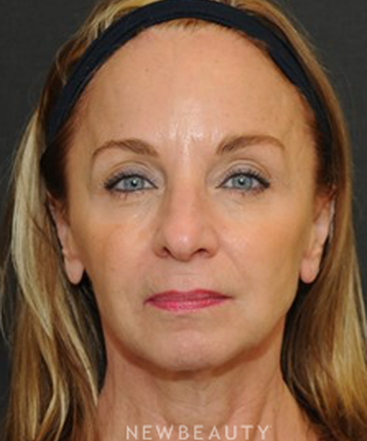dr-janet-allenby-botox-b