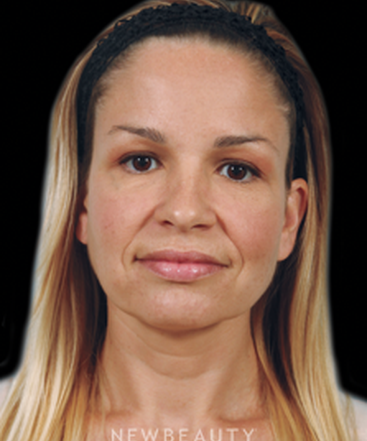 dr-kenneth-beer-injectables-fillers-b