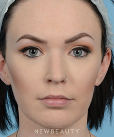 dr-jeffrey-wise-rhinoplasty-b
