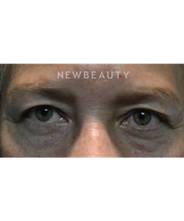 dr-baljeet-k-purewal-blepharoplasties-b