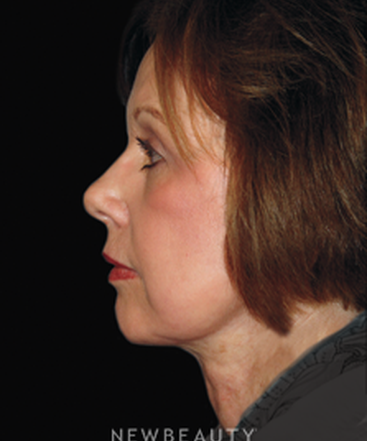 dr-brent-smith-lasers-eye-lift-mini-facelift-b