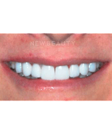dr-guy-lewis-veneers-b