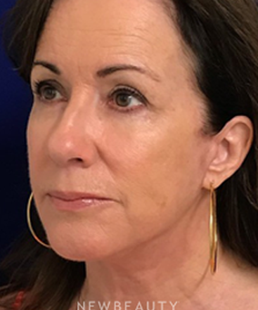 dr-dilip-madnani-facelift-b