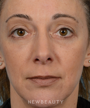 dr-jeffrey-b-wise-lower-blepharoplasty-b