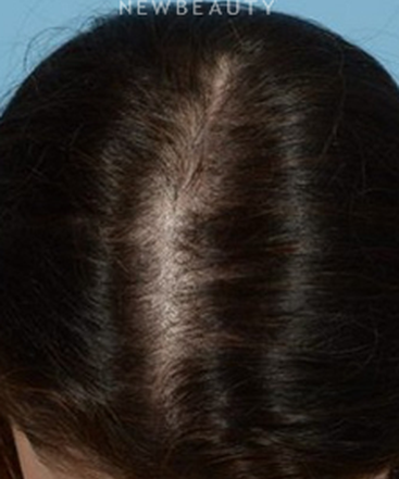 dr-jeffrey-wise-hair-loss-treatment-b