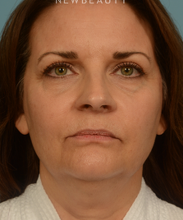 dr-bryan-gawley-facelift-b