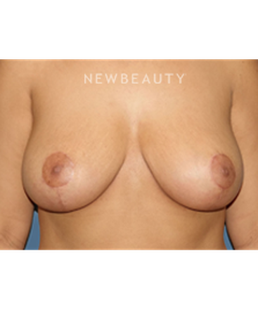 dr-bryan-gawley-breast-augmentation-b