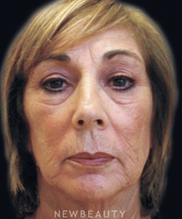 dr-janet-allenby-injectables-fillers-b