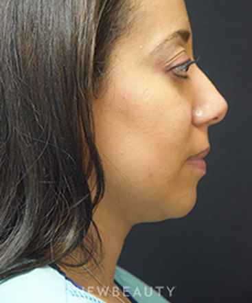 dr-jeffrey-b-wise-kybella-b