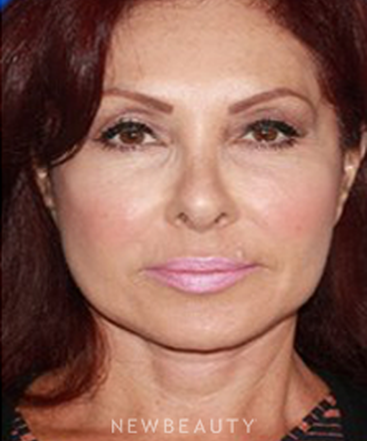 dr-konstantin-vasyukevich-facelift-b