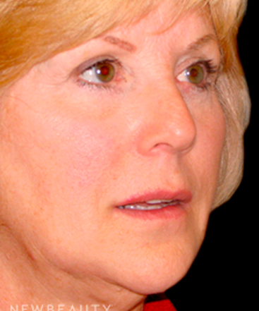 dr-tiffany-mccormack-facelift-b