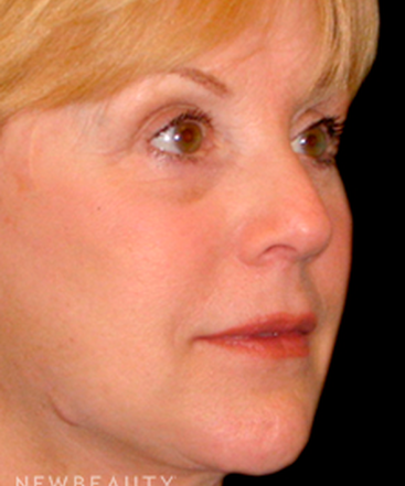 dr-tiffany-mccormack-facelift-b