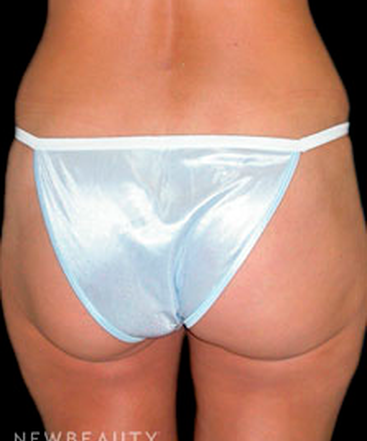 dr-tiffany-mccormack-liposuction-b