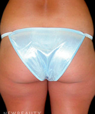 dr-tiffany-mccormack-liposuction-b