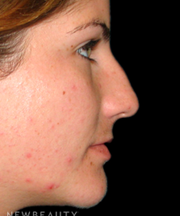 dr-tiffany-mccormack-rhinoplasty-b