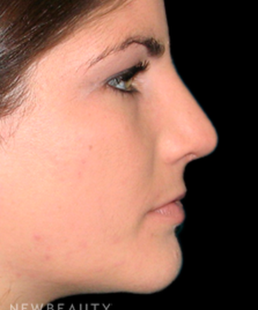 dr-tiffany-mccormack-rhinoplasty-b