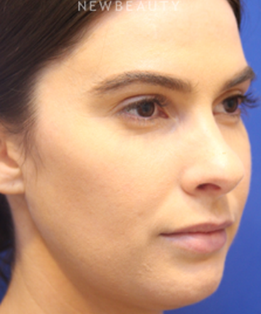 dr-jennifer-levine-lasers-b