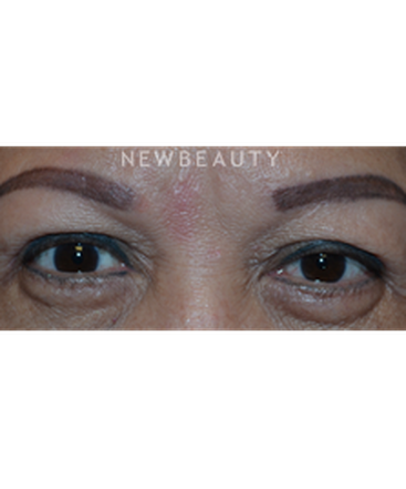 dr-baljeet-k-purewal-blepharoplasty-b