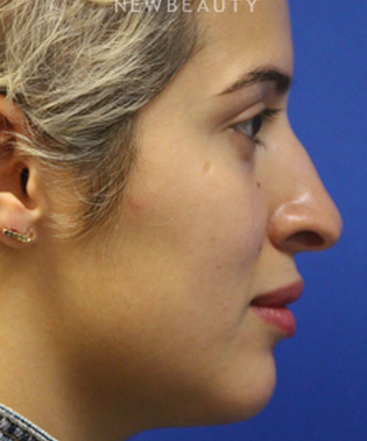 dr-jennifer-levine-rhinoplasty-b