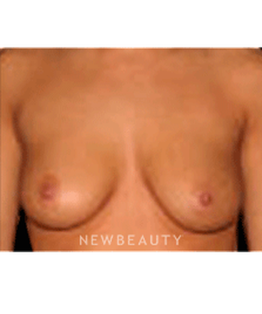 dr-sanjay-grover-breast-augmentation-b