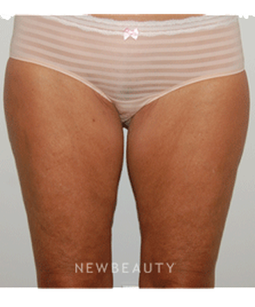 dr-david-p-rapaport-coolsculpting-b