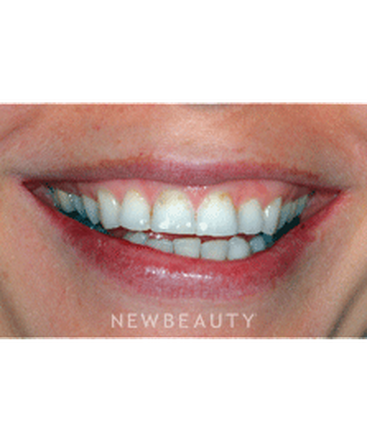 dr-ronald-goldstein-smile-makeover-crowns-whitening-gum-lift-contouring-b